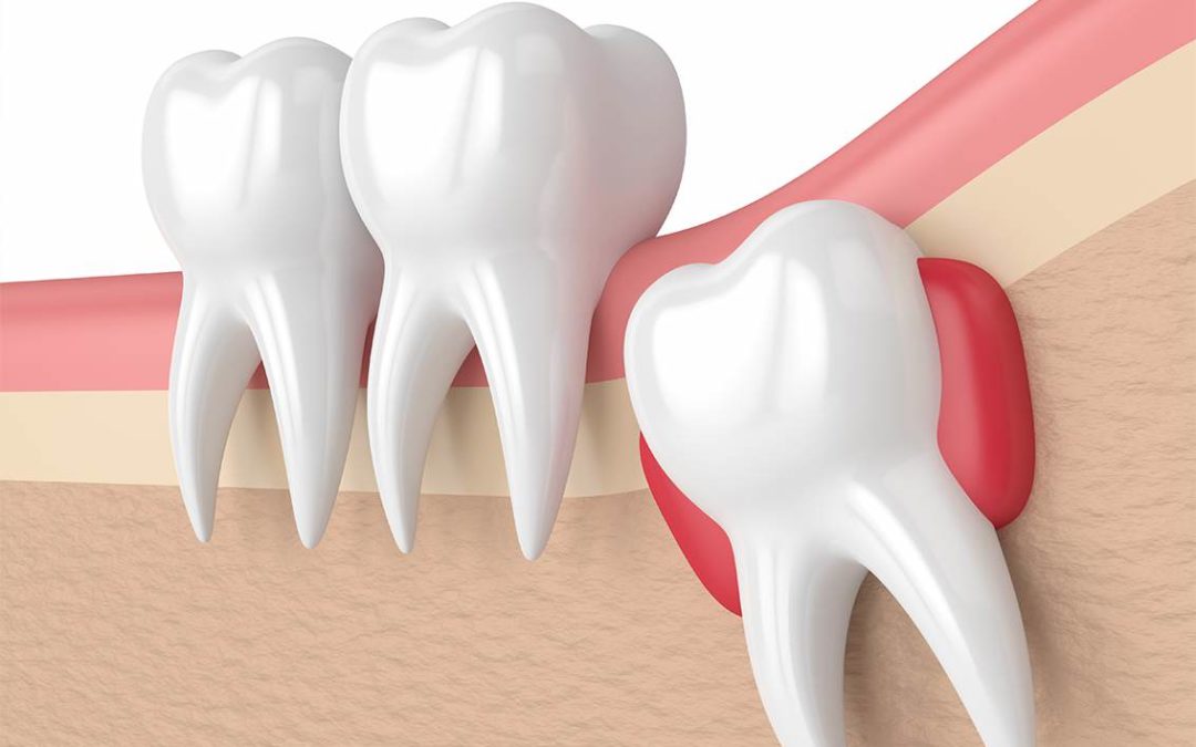 Why do you need to get your wisdom teeth checked?