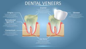 teeth veneers procedure cherrybrook